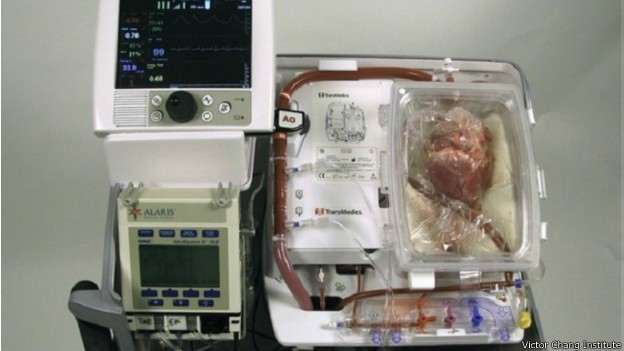 A máquina batizada de 'coração em caixa', que permitiu aos médicos manter o coração próprio para transplante  (Foto: BBC)