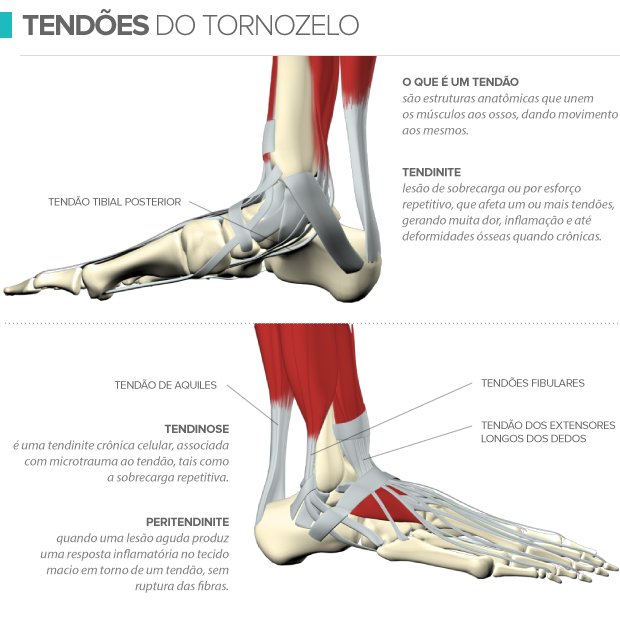 Tendinopatia é causada pelo excesso de uso dos tendões do pé e tornozelo
