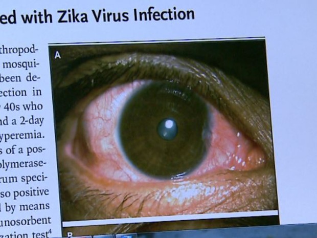 Estudo da USP de Ribeirão Preto relaciona inflamação ocular ao zika vírus (Foto: Fábio Júnior/EPTV)