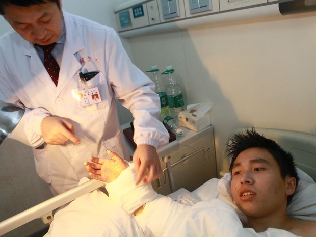 Após um mês com a mão junto ao tornozelo, chinês teve mão reimplantada no braço (Foto: HAP/Quircky China News/Rex  )