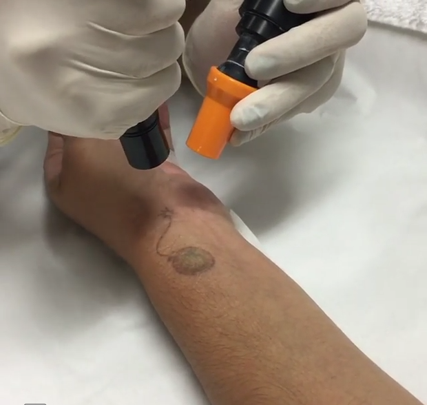 Andressa Urach removendo tatuagem (Foto: Reprodução/Instagram)