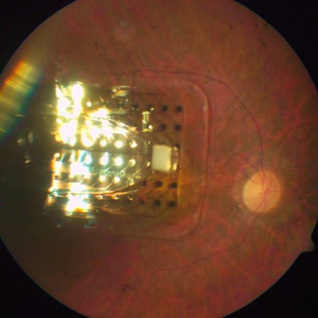 Chip implantado é implantado no olho por meio de cirurgia (Foto: Divulgação)