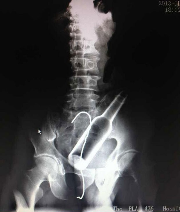 Radiografia mostra objetos do abdômen do chinês, antes de serem removidos pelos médicos (Foto:  HAP, Quirky China News/REX)