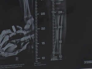 Exame de raio X mostra problema na perna do menino (Foto: Reprodução/TV TEM)