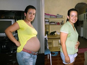 Mulher Com Cisto Gigante Recebe Alta E Mostra Resultado Da Cirurgia Santos E Regiao G1