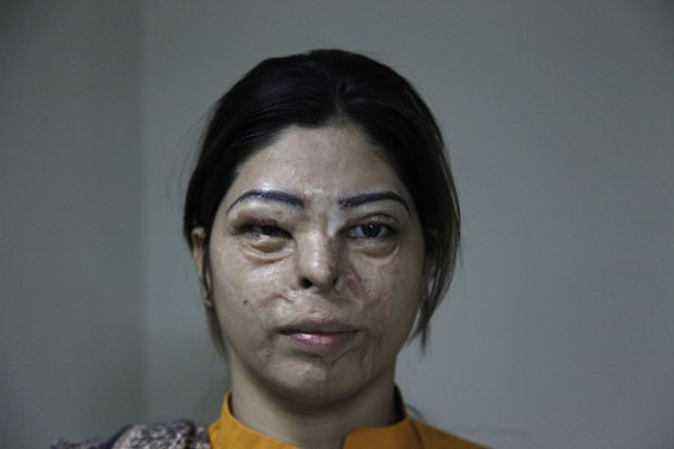 Entre as mulheres que passaram pela cirurgia está Kanwal Ashar, de 24 anos, que teve ácido jogado em seu rosto por um homem após ela recusar sua proposta de casamento. Outra mulher atendida pelo médico foi Kanwal Qayum, 26 anos, que foi vítima do ataque d (Foto: Shakil Adil/AP Images for Crown Clinic)