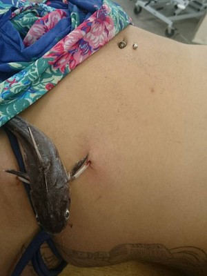 Turista teve que ser submetida a microcirurgia em Itanhaém, SP (Foto: Marcelo Araújo Tamada / Arquivo Pessoal)