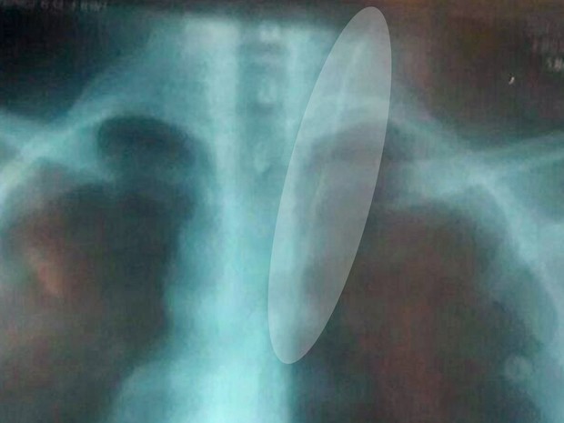 Imagem de raio X mostra fio-guia dentro na região do pescoço da vítima (Foto: Reprodução)