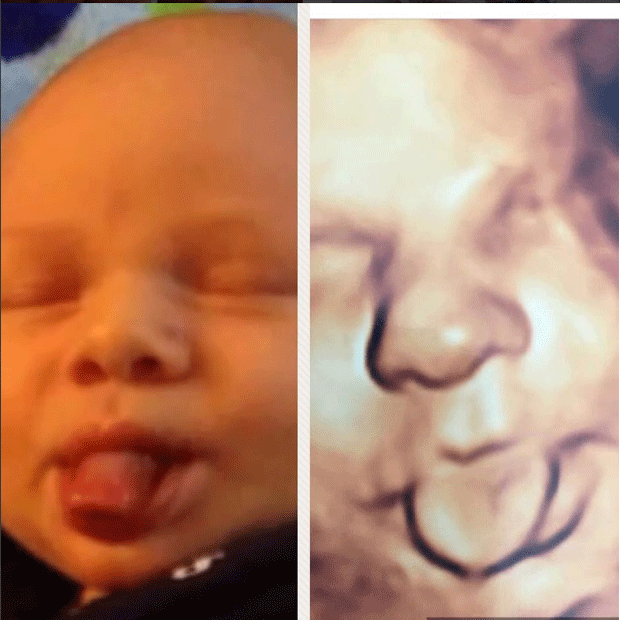 Bebês: antes e depois (Foto: Reprodução / Instagram)