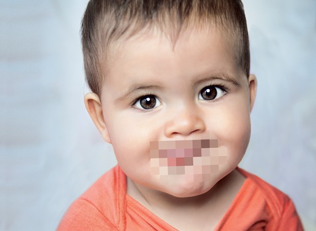estomatite; bebê; boca;  (Foto: Getty Images)