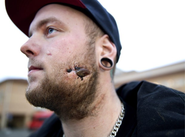 Patrik Moberg ficou com pedaço de garrafa no rosto por 17 dias após ser agredido em cruzeiro (Foto: IBL/REX)