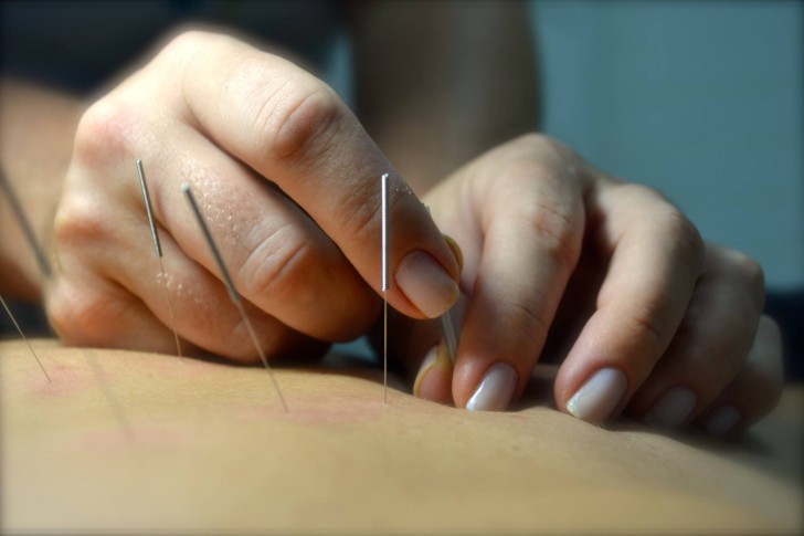 Acupuntura 3