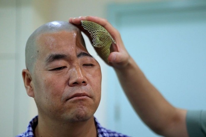 Homem tem crânio reconstruído graças a malha de metal criada por impressora 3D (Foto: Reprodução/China Daily) Homem tem crânio reconstruído graças a malha de metal criada por impressora 3D (Foto: Reprodução/China Daily)