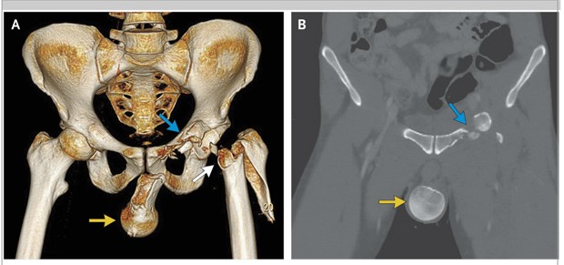  Exames de imagem mostram fratura: à esquerda, seta branca indica deslocamento de quadril e fratura no fêmur esquerdo; seta amarela mostra deslocamento da cabeça do fêmur para dentro do saco escrotal; seta azul mostra fratura do anel pélvico anterior e acetábulo (Foto: Andreas Schicho e Christoph Riepl/The New England Journal of Medicine)