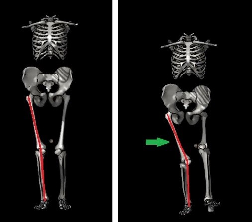Movimento de agachamento unipodal. Repare, na foto da  direita, no membro direito, na qual há uma inclinação do fêmur   na direção medial.