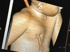 Imagem da tomografia computadorizada mostra estaca atravessada no tronco da criança (Foto: Divulgação/HUT)