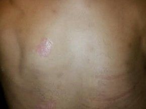Portador De Hanseniase Diz Que Se Isola Em Casa Para Nao Mostrar Corpo Tocantins G1