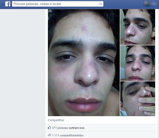 Jovem postou fotos em sua página na internet dos supostos hematomas causados pela agressão (Foto: Reprodução/Facebook)
