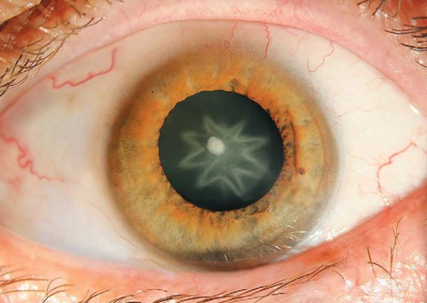Imagem de olho de paciente com catarata estrelada, resultado de um trauma sofrido pelo olho (Foto: Reprodução/Massachusetts Medical Society)