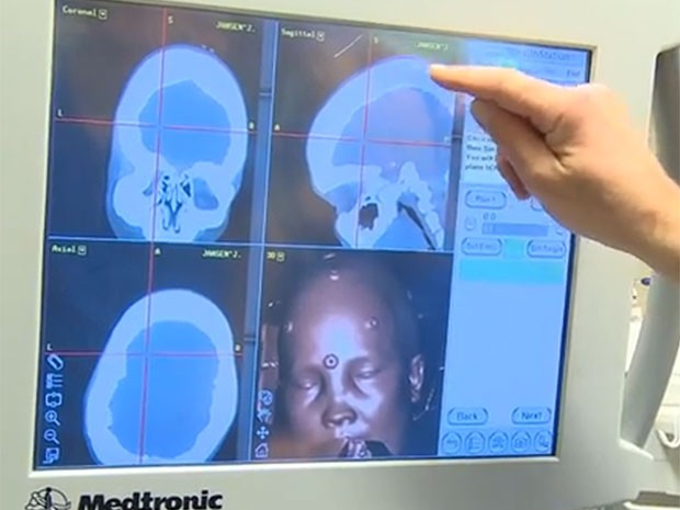 Mulher tinha doença rara que deixava o crânio com 5 cm de espessura (o normal é 1,5 cm) (Foto: Reprodução/YouTube/UMC Utrecht)