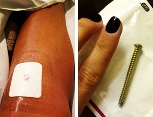 vôlei Natália parafuso perna (Foto: Instagram)