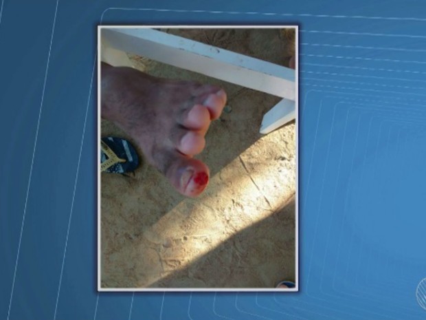 Banhistas mostram ferimentos nos pés após ataques (Foto: Reprodução / TV Bahia)