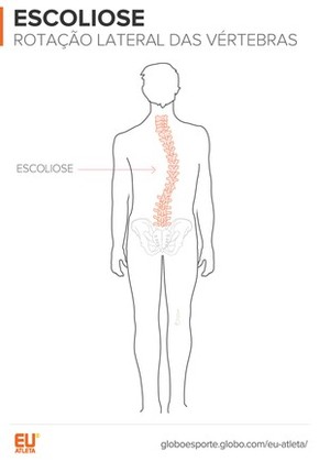 Lordose Cifose E Escoliose Os Desvios Na Coluna E A Relacao Com Exercicios Saude Globoesporte Com