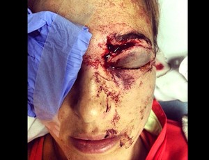 Morgan Beck leva tacada no olho esquerdo (Foto: Reprodução)