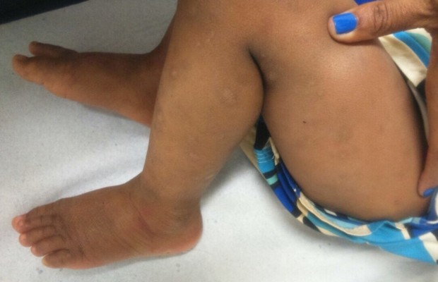 Criança possui hematomas antigos de agressões, o que pode indicar tortura em Aparecida de Goiânia, Goiás (Foto: Arquivo Pessoal/Deidiane Rodrigues)