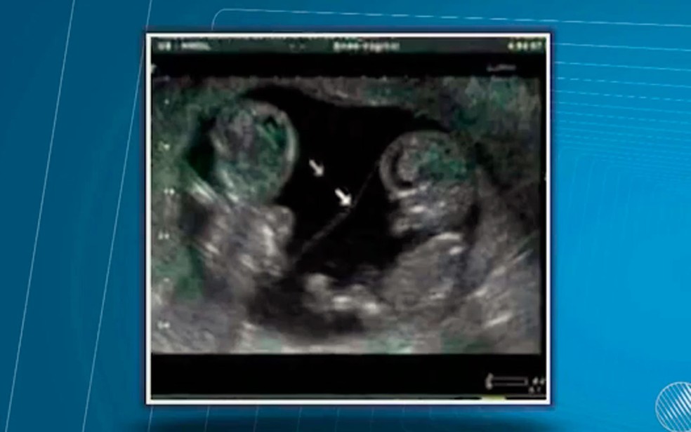 Último ultrassom que Cleidiane disse ter feito mostra dois fetos. (Foto: Reprodução/TV Santa Cruz)
