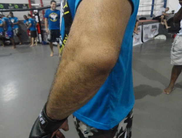 Cotovelo de Marcelo Guimarães lesionado (Foto: Richard Pinheiro)