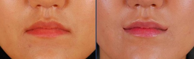 Cirurgia plástica desenvolvida na Coréia altera o canto da boca para formar um sorriso permanente (Foto: Reprodução Youtube/Aone Plastic & Aesthetic Surgery)