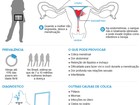 Endometriose é a principal causa de infertilidade das mulheres no país