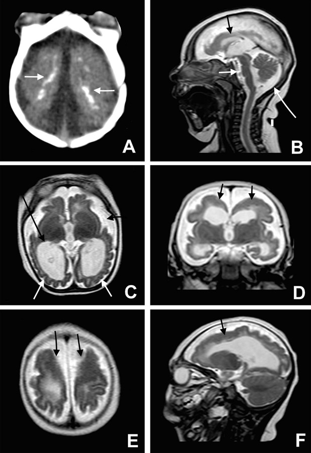  Imagem mostra exame de imagem de bebês com microcefalia, que revelam calcificações e malformação cortical  (Foto: BMJ 2015/ http://www.bmj.com/cgi/doi/10.1136/bmj.i1901 )