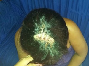 Mulher levou pontos na cabeça após ser agredida por um rapaz que conheceu há dois dias  (Foto: Adelcimar Carvalho/G1)