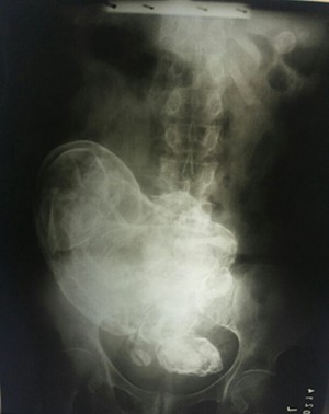 Segundo a ginecologista, o corpo da idosa encontrou uma forma de conviver com o feto (Foto: Divulgação)