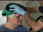 Técnica promete reverter queda de cabelos causada pela quimioterapia