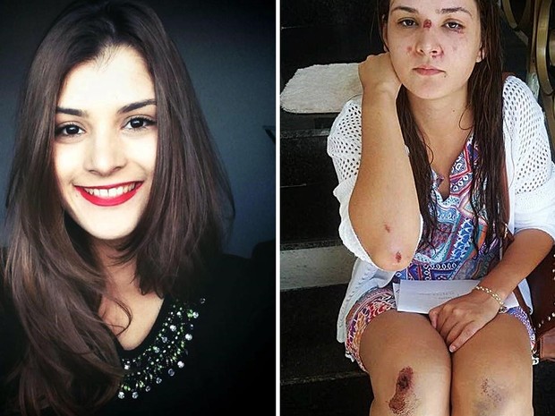 A estudante de odontologia Poanka Faleiros, mostra machucados que ela diz terem sido provocados por pelo então namorado (Foto: Panka Faleiros/Arquivo Pessoal)