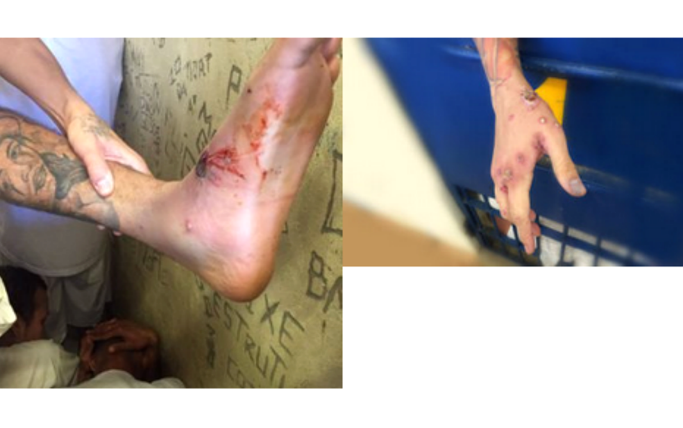 Sindicato dos Agentes Penitenciários do DF publicou imagens de detentos da Papuda com sintomas de doença infecciosa  (Foto: Sindicato dos Agentes Penitenciários/Divulgação)