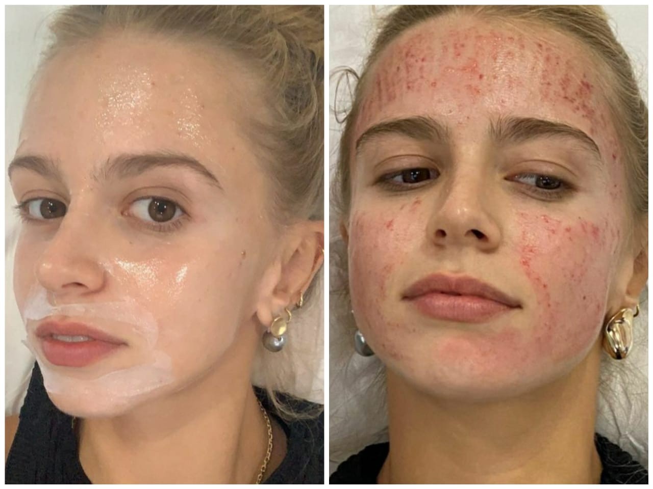Isabella Scherer faz tratamento estético facial (Foto: Reprodução/Instagram) Isabella Scherer faz tratamento estético facial (Foto: Reprodução/Instagram)