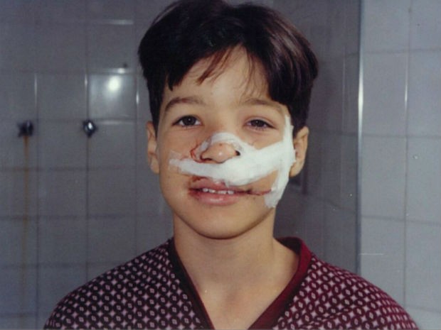 Morador de Sobradinho, Erick Lopes, após fazer cirurgia de retirada de tumor no nariz (Foto: Erick Lopes/Arquivo Pessoal)