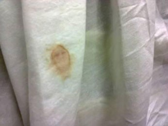 Imagem formada por um pingo de sangue em lençol, que lembra rosto de Nossa Senhora de Fátima (Foto: Divulgação / Hospital Regional de Limoeiro)