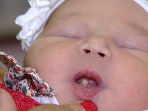 Bebê nasceu com um dente já formado (Foto: Reprodução/RBS TV)