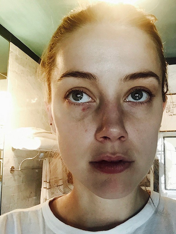 A atriz Amber Heard com machucados após as supostas agressões de Johnny Depp (Foto: Reprodução)