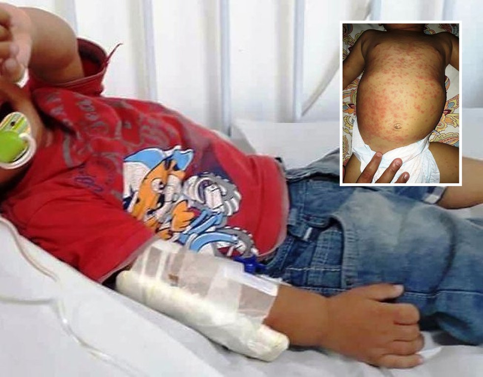 Menino foi internado com alergia em Bertioga  (Foto: Arquivo Pessoal)