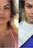 Natalia Casassola faz bichectomia e mostra antes e depois em fotos