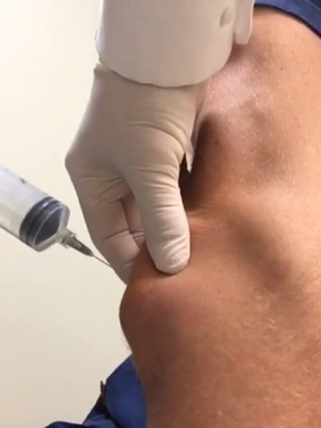 Tem Dor De Cotovelo Conheca Lesao Que Afeta Tenistas E Mais Profissionais Saude Globoesporte Com