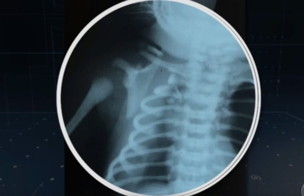 Imagem de exame mostra lesões no organismo de bebê atingido por bala perdida na barriga da mãe (Foto: Reprodução/TV Globo)