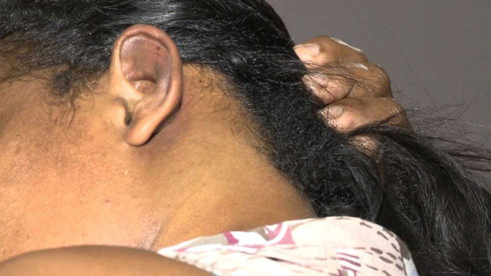 Zeladora mostra marcas de agressão no corpo, na semana da agressão (Foto: Arquivo/ TV Gazeta)