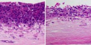 Células de câncer de próstata mais agressivo, que não puderam ser alteradas pela enzima, à esquerda; à direita, células do tumor mais controladas, com atuação da substância (Foto: Divulgação/Instituto de Pesquisa Médica Sanford-Burnham)